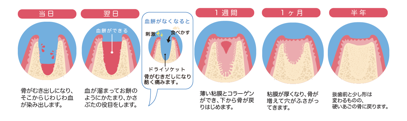 親知らず抜歯後に血餅ができ、歯茎と骨が回復していく過程