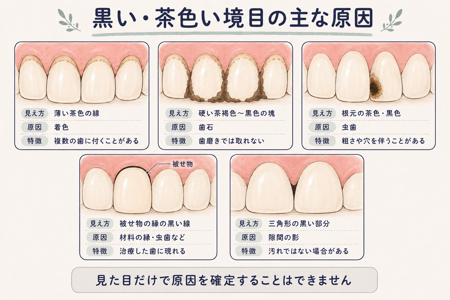 歯と歯茎の境目が黒色・茶色に見える主な原因の図解