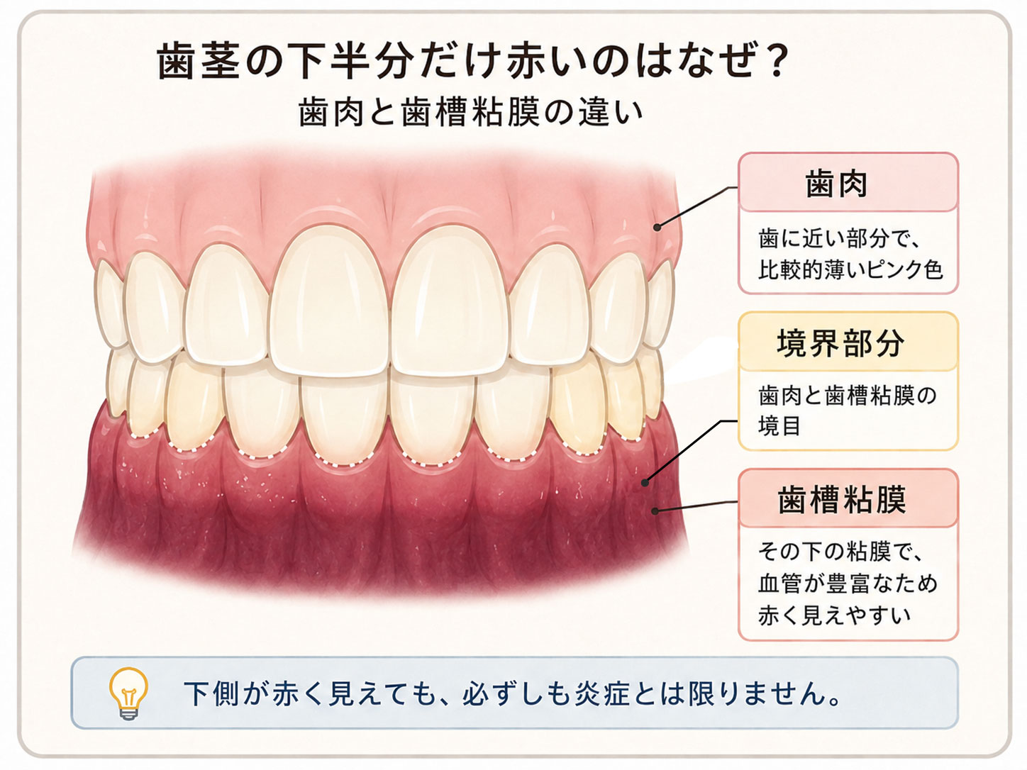 歯茎の下半分が赤く見える歯肉と歯槽粘膜の違いを示したイラスト