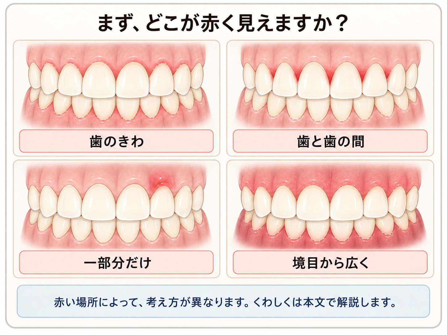 歯茎が赤く見える場所を「歯のきわ・歯と歯の間・一部分だけ・境目から広く」の4パターンで示した図
